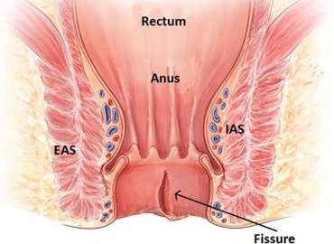 Anal fissure anatomy