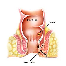 Anal fistula anatomy