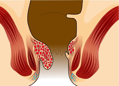 Piles (Haemorrhoids) anatomy
