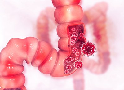 Rectal polyp anatomy