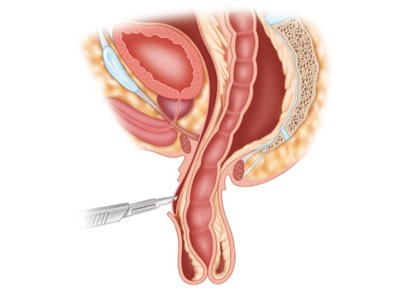 Rectal prolapse anatomy